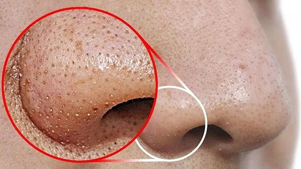 Điều trị mụn trứng cá