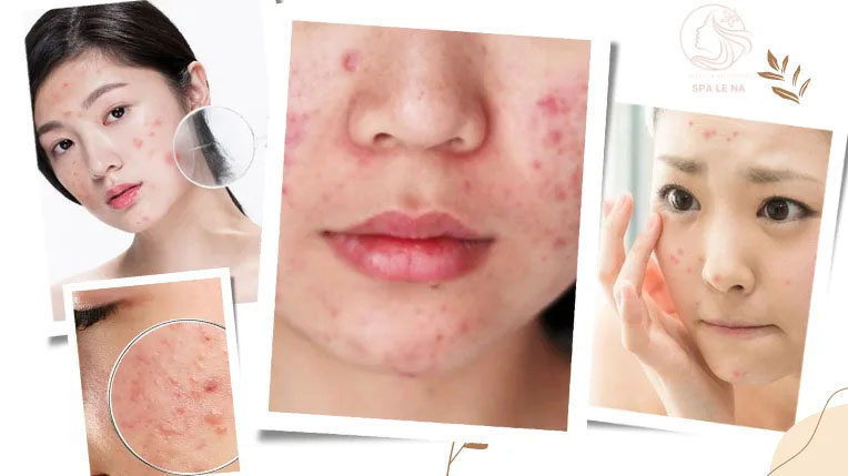Điều trị mụn tuổi dậy thị