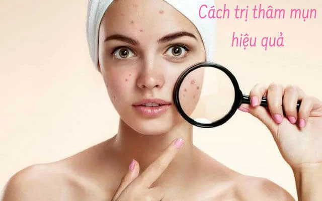 Điều trị mụn thâm hiệu quả