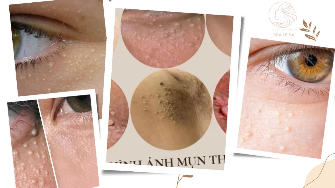Điều trị mụn thịt