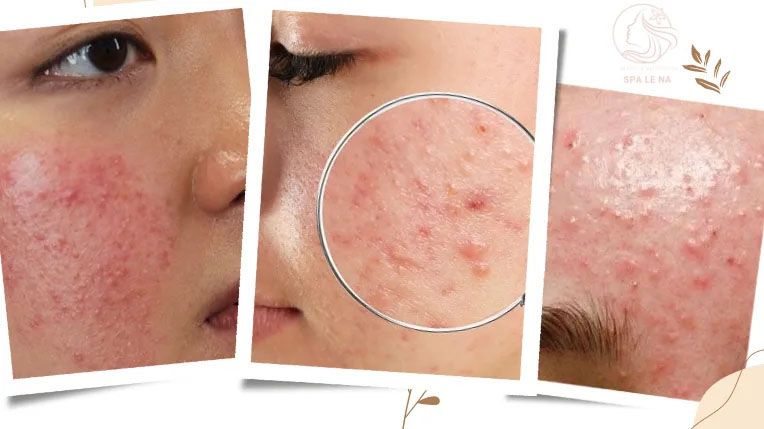 Điều trị mụn ẩn, mụn viêm đỏ