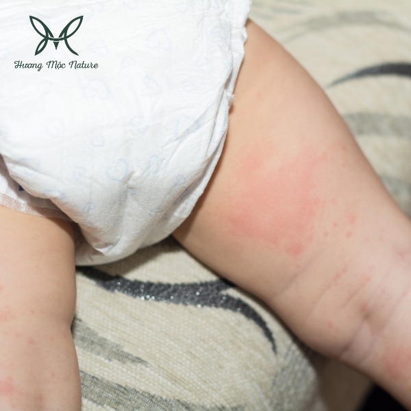 Gia công kem bôi da chống hăm cho bé