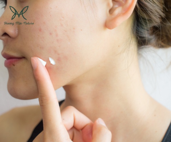 Gia công kem trị mụn cho bà bầu