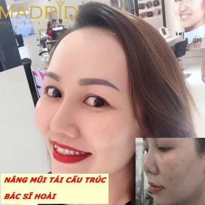 Nâng mũi tái cấu trúc