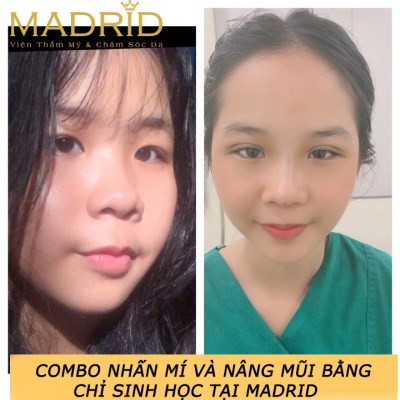 Nhấn mí và nâng mũi