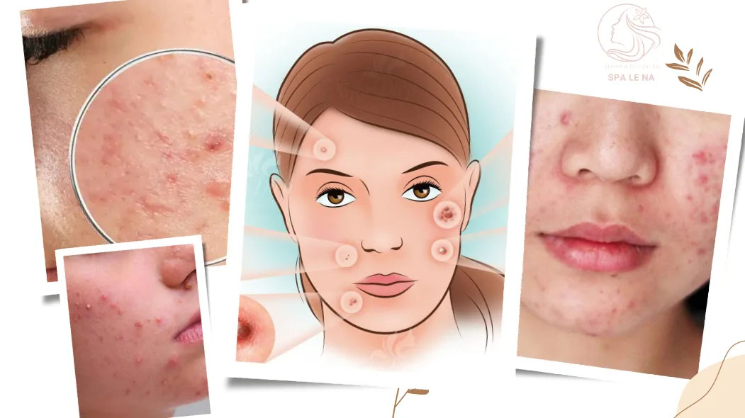 Điều trị mụn trứng cá