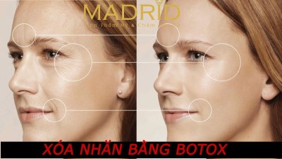 Xóa nhăn bằng boxtox